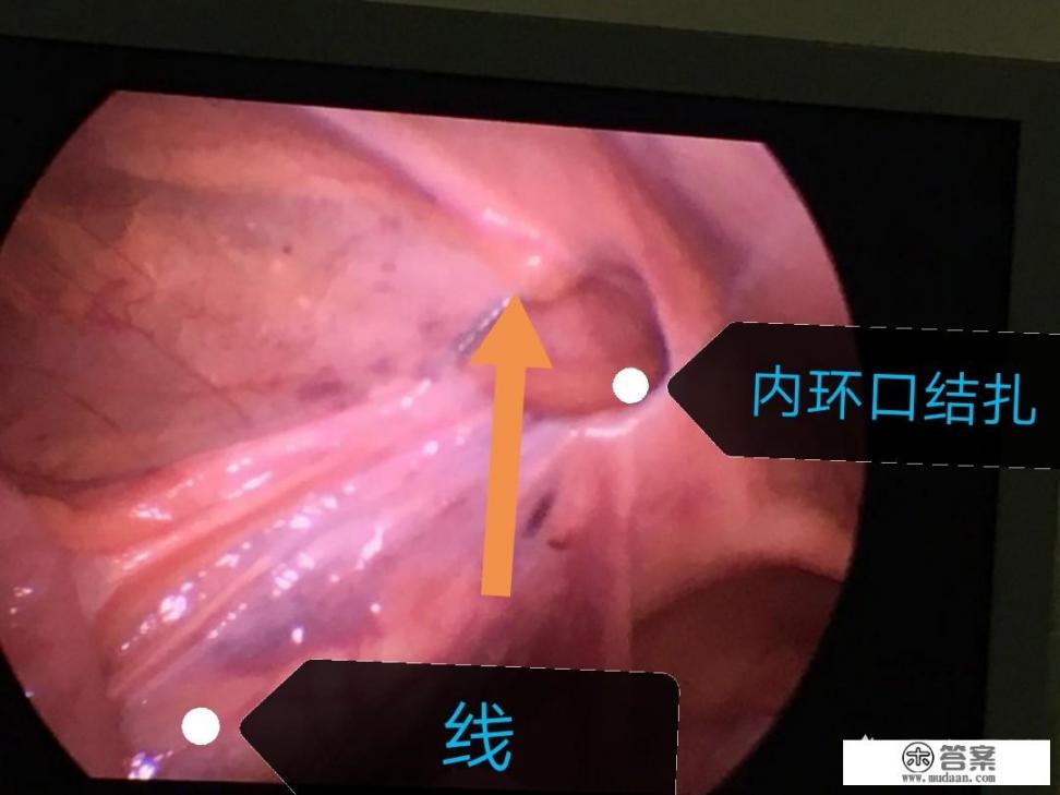 5岁多小孩疝气,哪种手术方式比较好?腹腔镜手术真的好吗? 5岁多小孩疝气,哪种手术方式比较好?腹腔镜手术真的好吗?