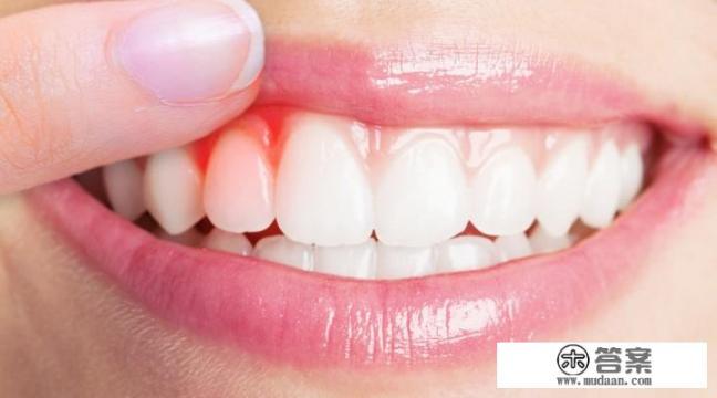 牙龈出血治疗方法有哪些？