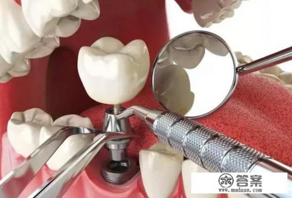 什么是种植牙，如何种植？