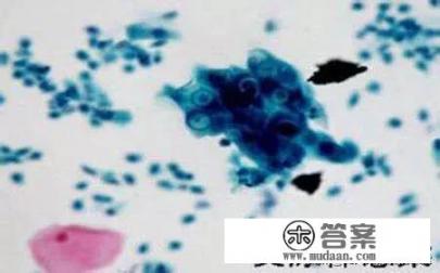 支原体感染是怎么回事？