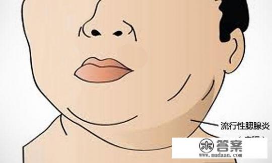 腮腺炎的症状及治疗办法是什么？