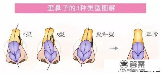 为什么很多人的鼻中隔都是偏的？鼻中隔偏曲是否需要治疗？