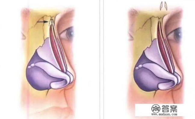 为什么很多人的鼻中隔都是偏的？鼻中隔偏曲是否需要治疗？