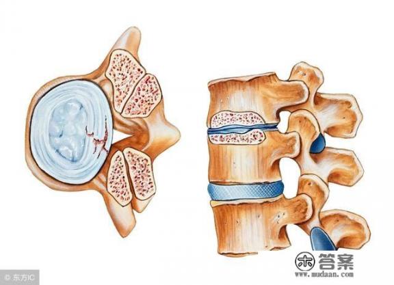 什么是坐骨神经疼？