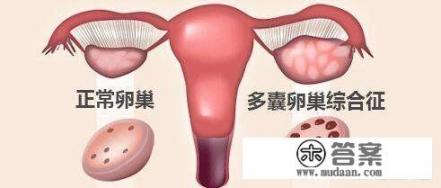 多囊卵巢综合症是什么意思? 多囊卵巢综合症是什么意思?