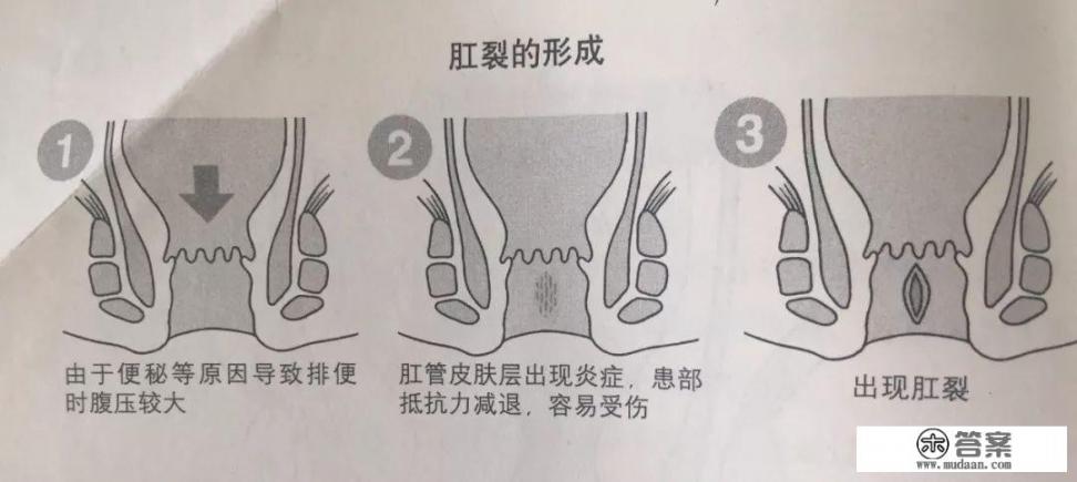 肛裂该怎么办? 肛裂该怎么办?