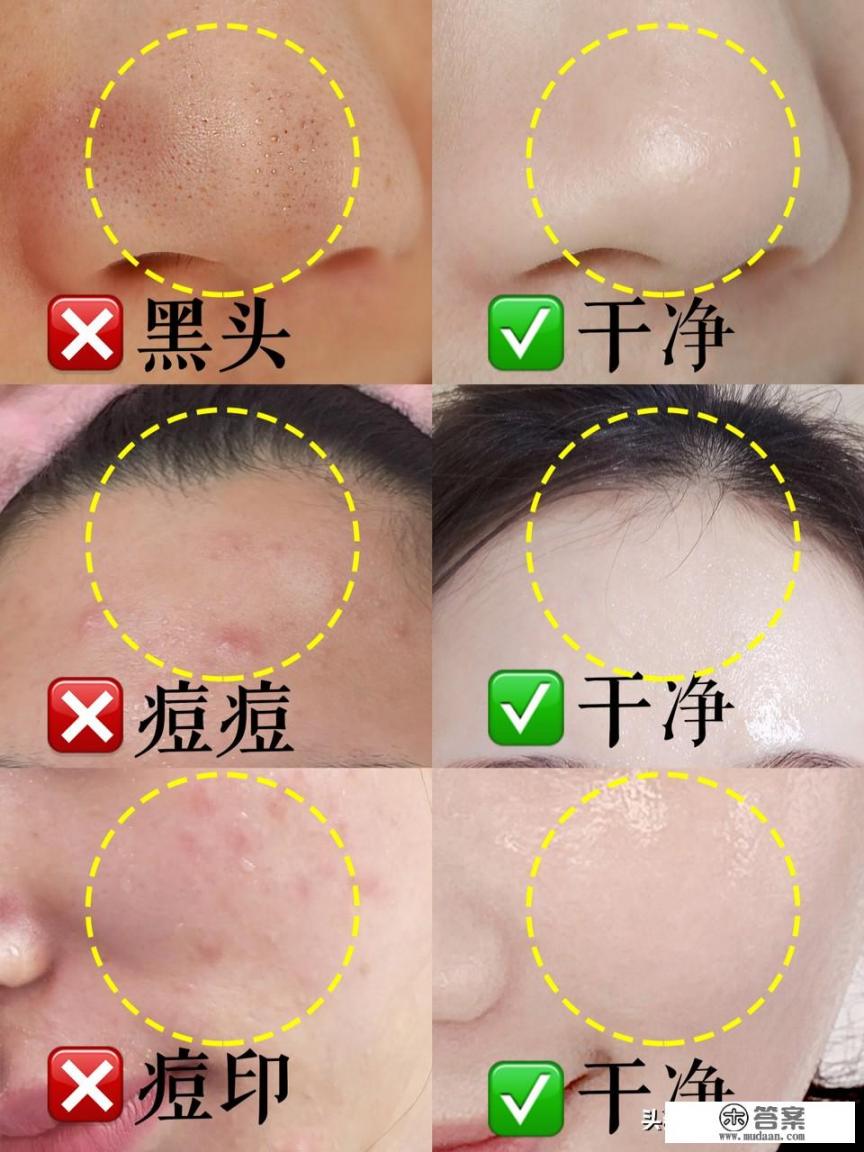 怎么样才能最快的去掉痘痘？