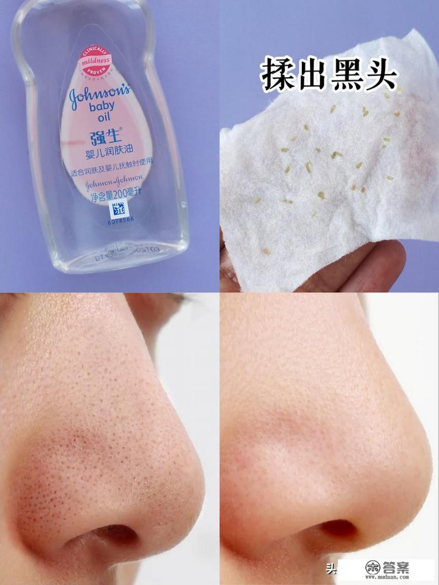 怎么样才能最快的去掉痘痘？