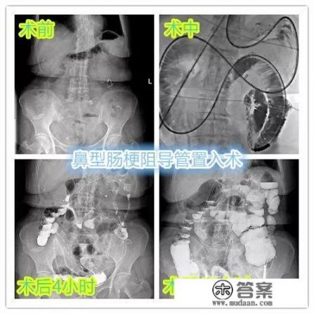 肠梗阻怎么回事？