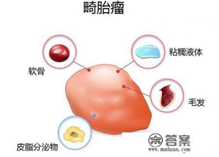 什么是畸胎瘤?什么原因形成的？