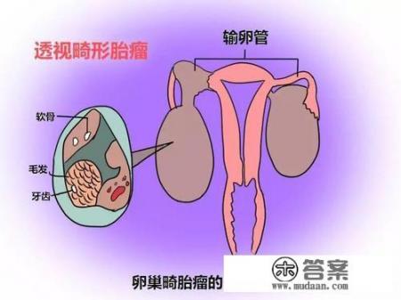 什么是畸胎瘤?什么原因形成的？