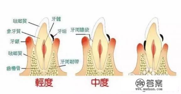 得了牙周炎怎么办？