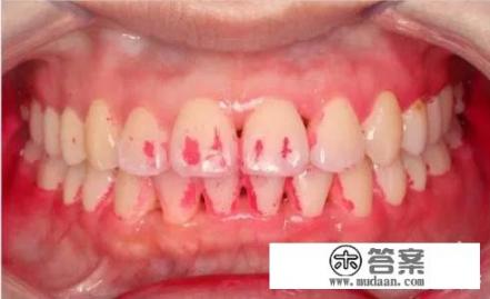 得了牙周炎怎么办？