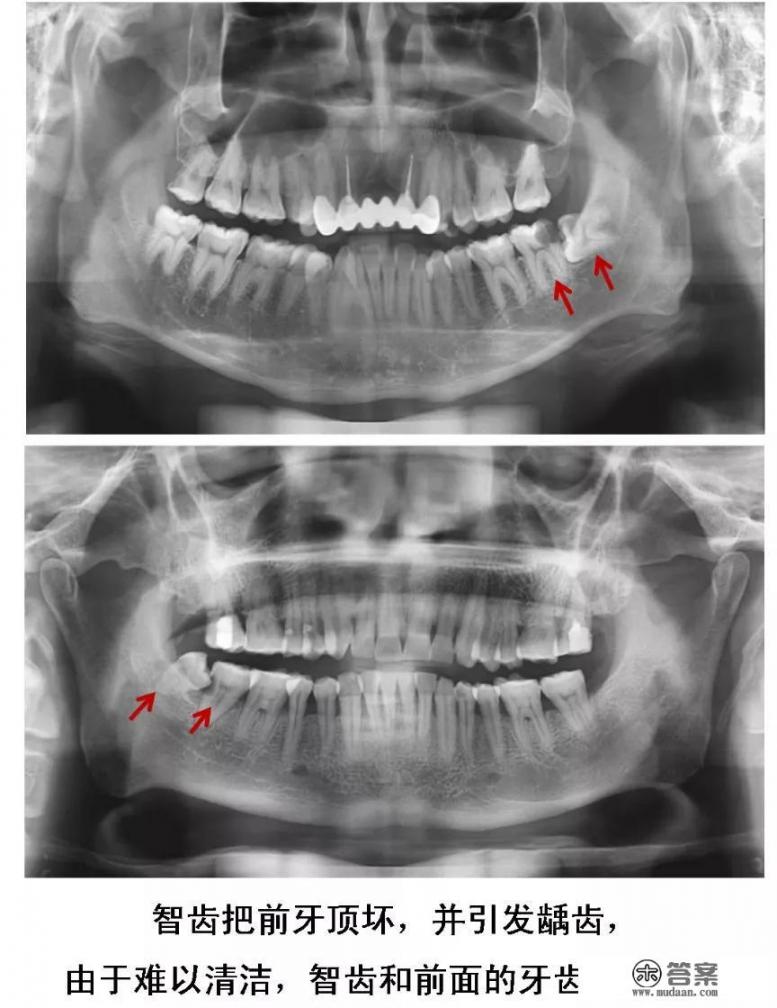 长了智齿一定要拔吗？