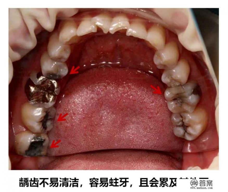 长了智齿一定要拔吗？