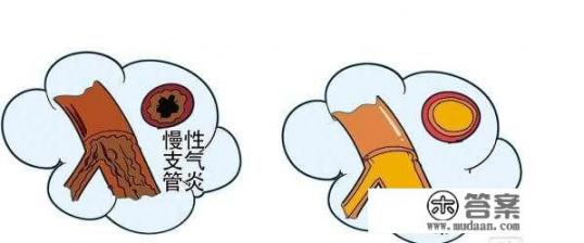 什么是慢性支气管炎疾病？