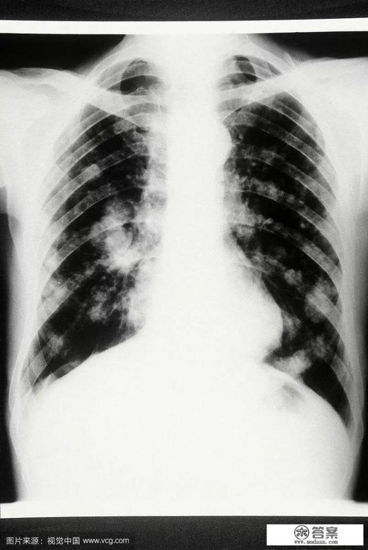 卡介苗是什么? 卡介苗是什么?