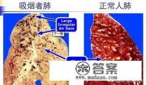 慢阻肺是什么？