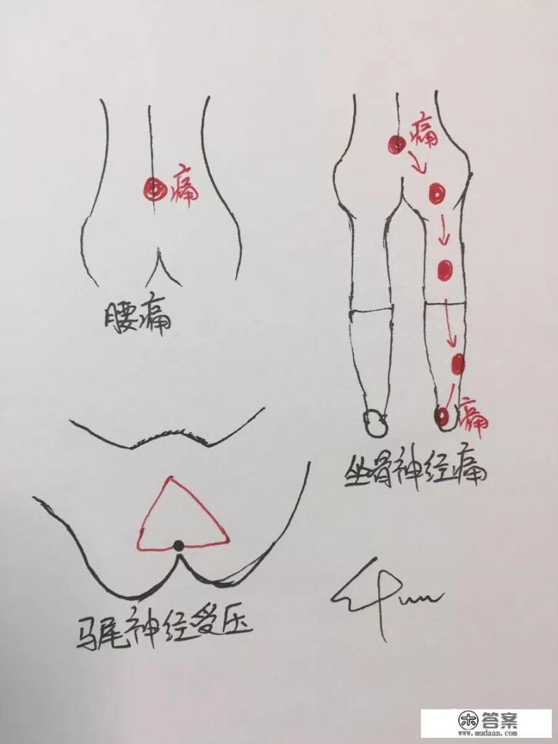 腰椎间盘突出症是什么? 腰椎间盘突出症是什么?