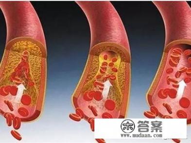 脑供血不足,会有什么表现?怎么改善? 脑供血不足,会有什么表现?怎么改善?