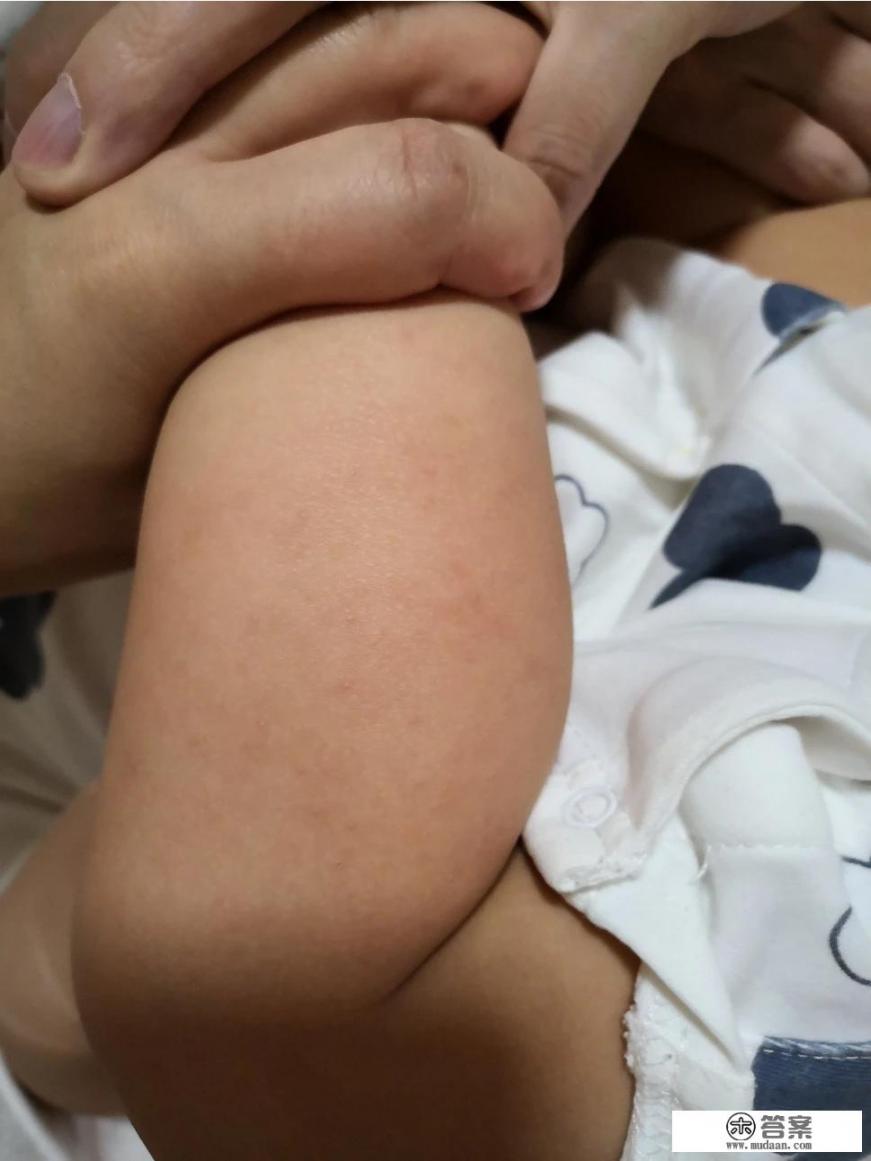 婴儿急疹怎么办? 婴儿急疹怎么办?