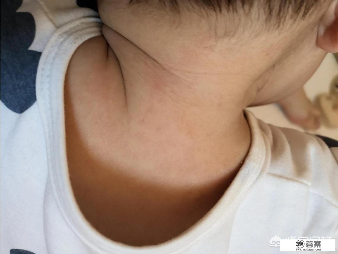 婴儿急疹怎么办? 婴儿急疹怎么办?