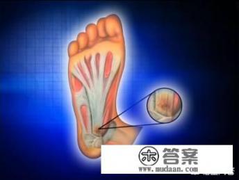 脚底筋膜炎怎么治? 脚底筋膜炎怎么治?