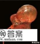 肾囊肿如何消除？