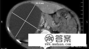 肾囊肿如何消除？