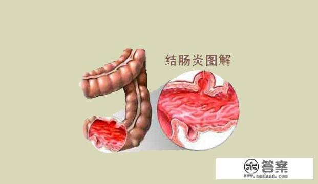 结肠炎怎么治？