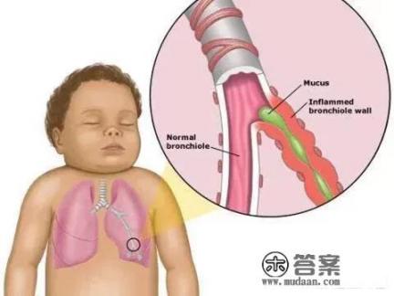 呼吸道合胞病毒是什么意思? 呼吸道合胞病毒是什么意思?