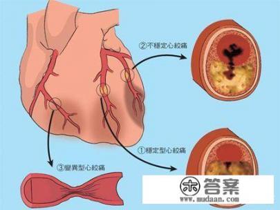 心绞痛介绍，心绞痛是什么病？