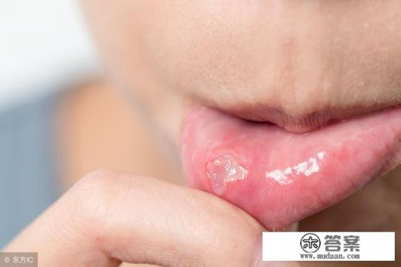 口腔溃疡该吃什么药？
