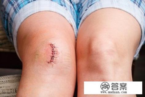 类风湿性关节炎有什么忌口？