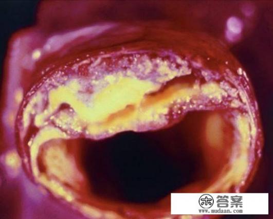 动脉硬化吃什么药？