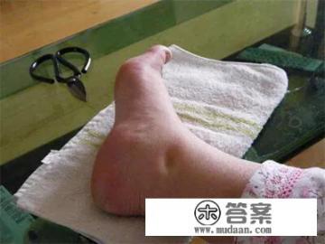 #你吃对了吗#下肢水肿患者饮食要注意什么？