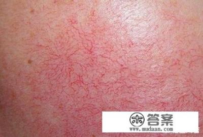 如何去掉红血丝？