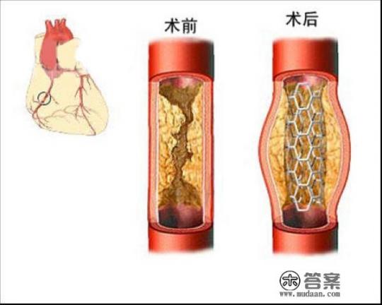 发现心梗为什么要等病情稳定后安排手术？