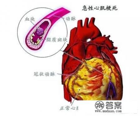 发现心梗为什么要等病情稳定后安排手术？