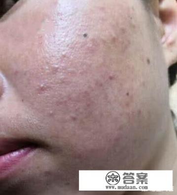 红血丝怎么去除？