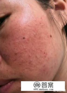 红血丝怎么去除？