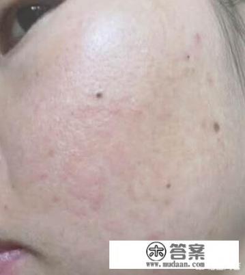 红血丝怎么去除？