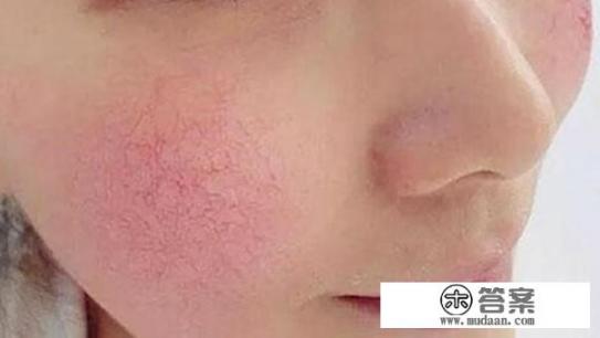 去红血丝的小妙招有哪些? 去红血丝的小妙招有哪些?