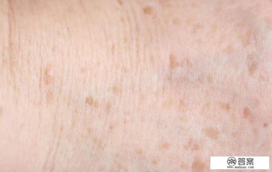 如何祛除老年斑和黄褐斑？