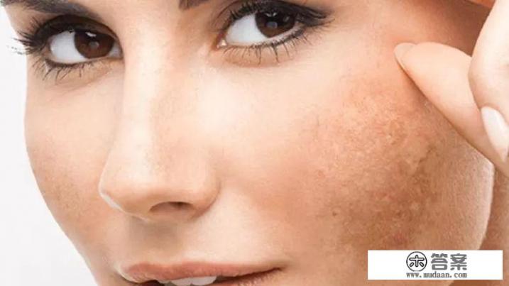 如何祛除老年斑和黄褐斑？