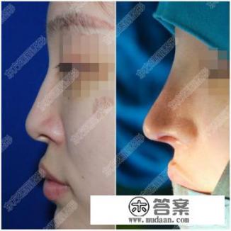 硅胶加耳，软骨隆鼻是不是会有很多后遗症？