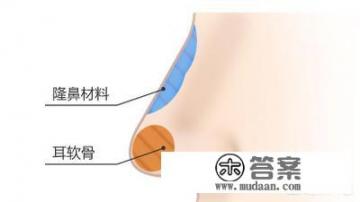 硅胶加耳，软骨隆鼻是不是会有很多后遗症？