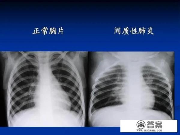 为什么阳了以后老是咳嗽？