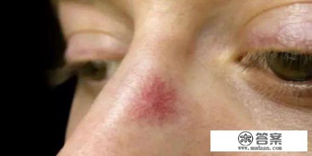 肝脏“变硬”，身体有6种迹象，该如何养护肝脏健康？