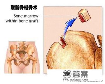 骨折手术取自己骨头好吗？
